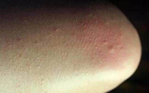 皮肤瘙痒症的典型症状如下所示