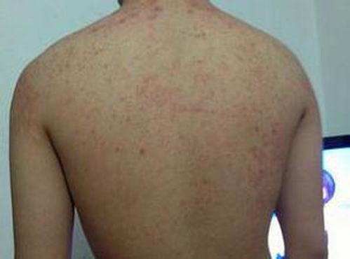 皮肤瘙痒的常见病因包括什么呢