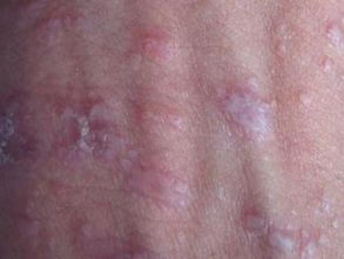 老年人该怎样的预防皮肤瘙痒呢