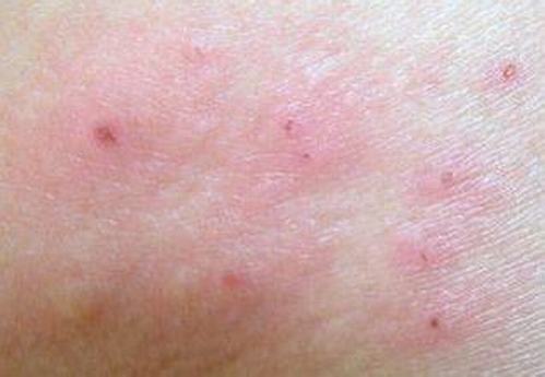导致皮肤瘙痒起红疹有哪些原因