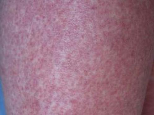 引起皮肤瘙痒的原因是什么呢