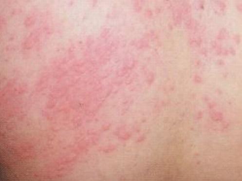 怎么避免皮肤瘙痒带来的危害