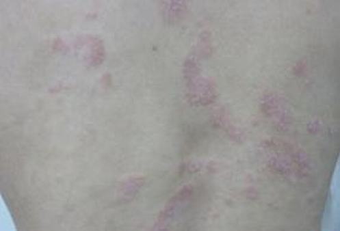 皮肤瘙痒症是哪些因素造成的
