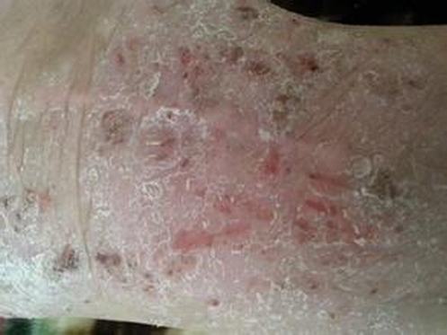 皮肤瘙痒症的症状表现有哪些