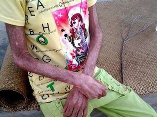 多发性肌炎的生活调理