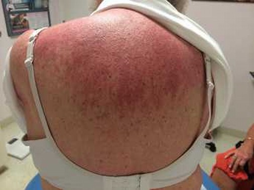皮肌炎康复的关键是什么