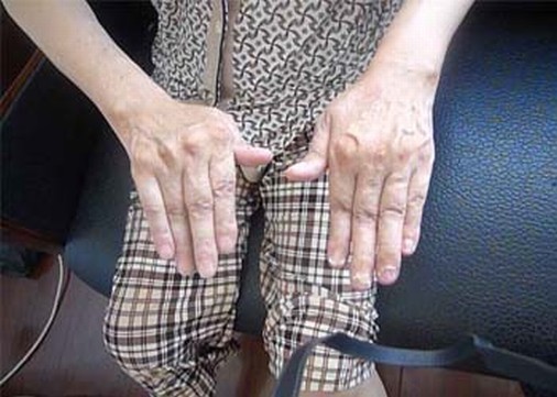 皮肌炎容易对患者造成何种危害