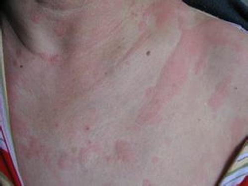 对于皮炎这种皮肤病的治疗原则