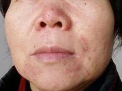 夏季滥用止汗液易致过敏性皮炎