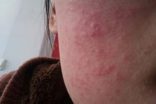 生活中如何才可以预防过敏性皮炎的发生