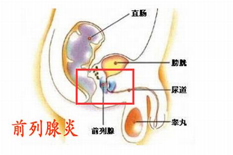 预防前列腺炎疾病要做到哪些