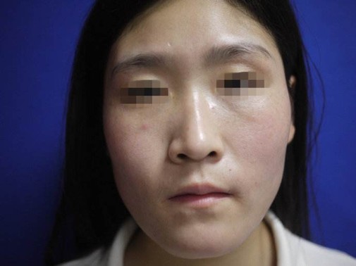 对于雀斑我们应该怎样的预防