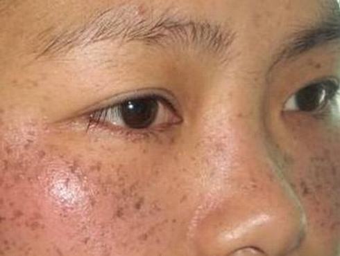 怎样做好雀斑的日常护理怎样做呢