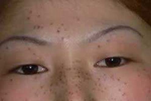 雀斑造成的影响有哪些