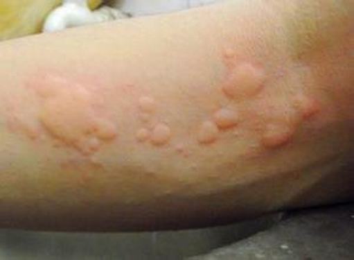 得了丘疹性荨麻疹有什么损害呢