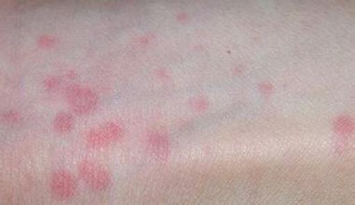 丘疹性荨麻疹的症状表现都有哪些呢