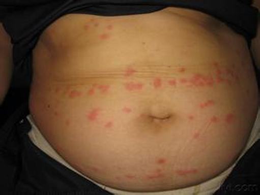 小儿丘疹性荨麻疹的需要加以注意