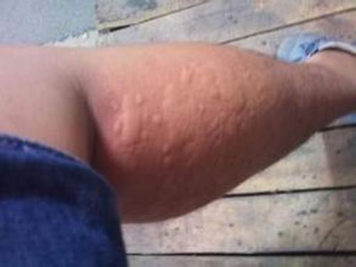 夏季怎样注意丘疹性荨麻疹侵袭呢