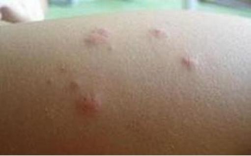 夏季蚊虫叮咬小心演变丘疹性荨麻疹