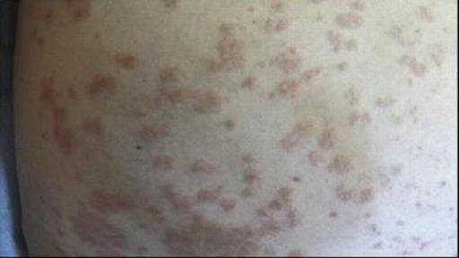冬季该怎么预防丘疹性荨麻疹