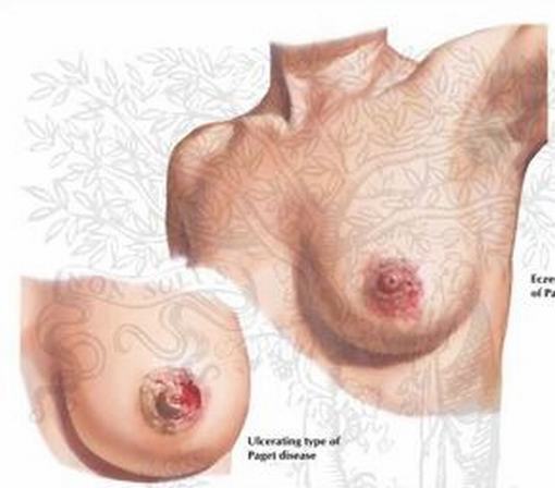 乳房湿疹应怎么治疗呢