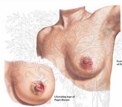 女性乳房湿疹有何特征