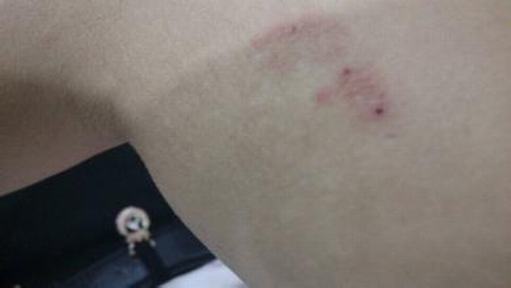 三期梅毒症状特点