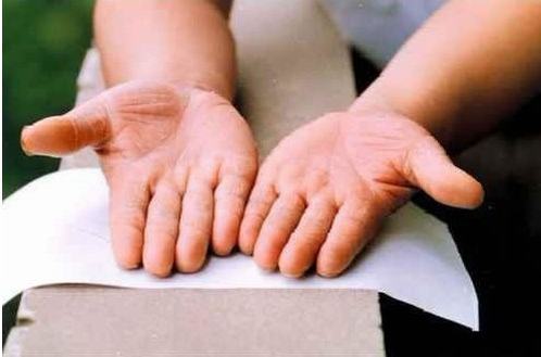 治疗手癣需要关注什么问题