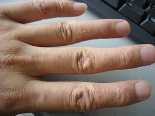 手癣与足癣的临床症状有哪些