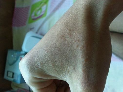 手痒脱皮是患有手癣吗