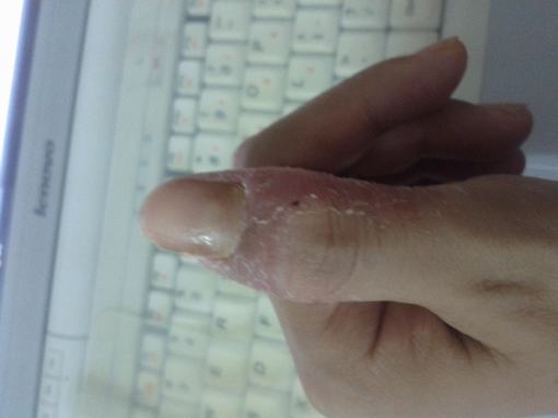 手癣是怎么发生的-