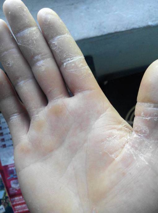 夏季预防手癣要注意这些