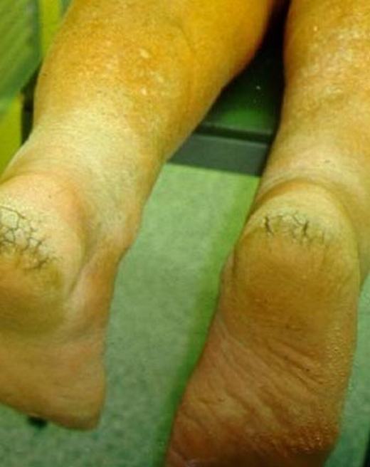 手足皲裂有什么症状表现呢