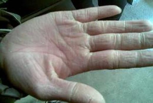 治疗手足皲裂使用偏方