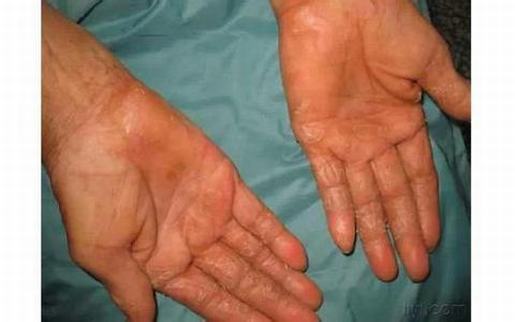 手足皲裂症状的预防说明