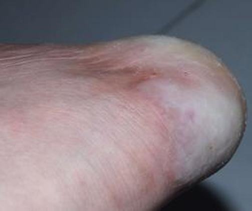 手足癣有哪几种症状类型