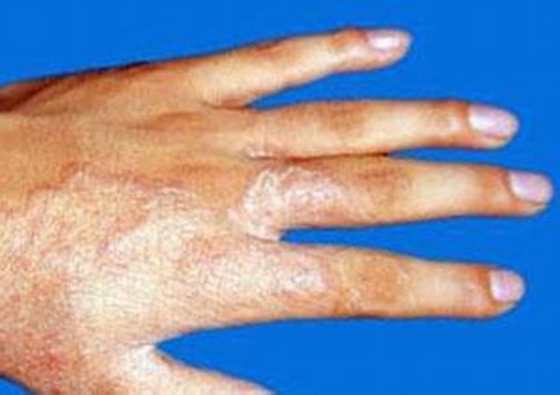 手足癣有哪些临床症状