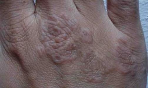 水疱型足癣皮肤病症状是什么
