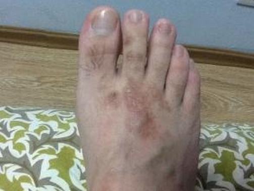 治疗香港脚需要注意的事项有哪些