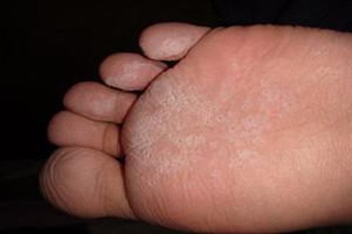 手足癣初期症状包括如下几点