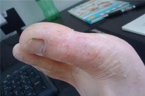 手足癣的临床表现有哪些呢