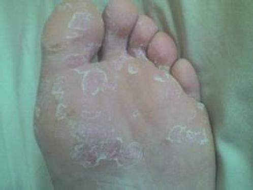 手足癣都有什么主要症状呢
