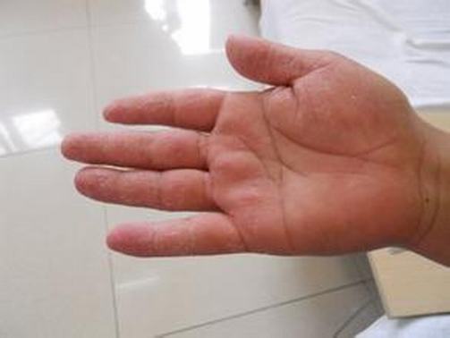 手足癣患者如何预防病情加重