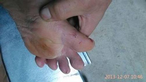 手足癣疾病的临床症状有哪些表现