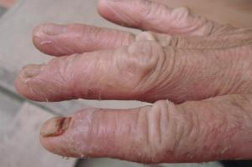 手足癣皮肤病日常护理方法