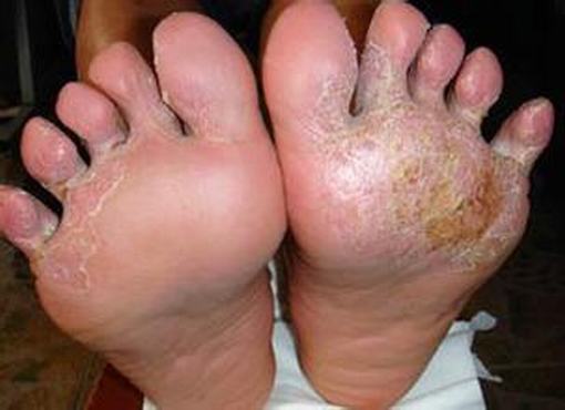 手足癣患者的饮食护理怎么做
