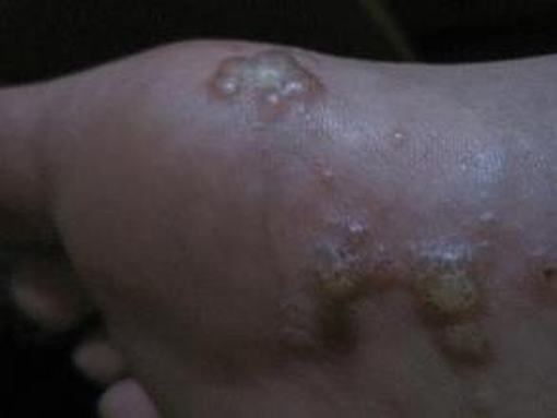 手足癣都有哪些症状