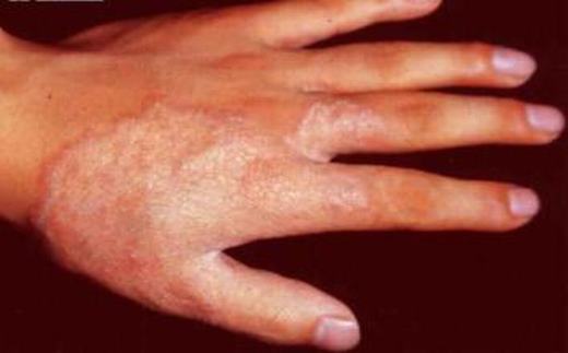 手足癣有哪些典型症状