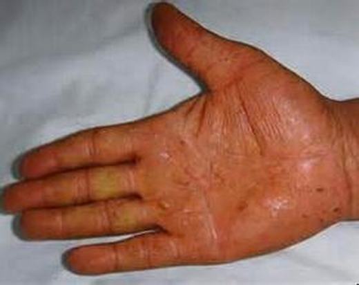 手足癣一般有哪些症状呢