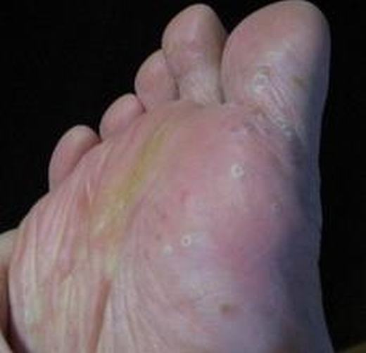 水泡型手足癣症状是什么